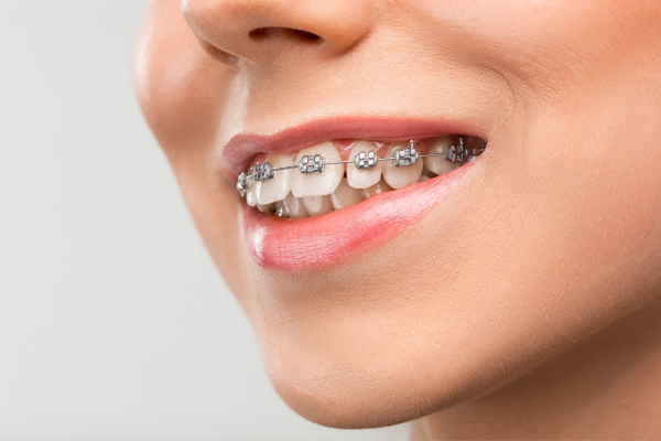 Braces Adjustment