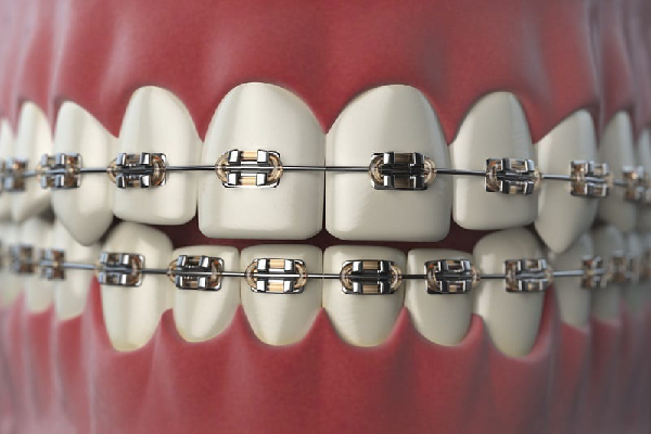 Retainer Phase
