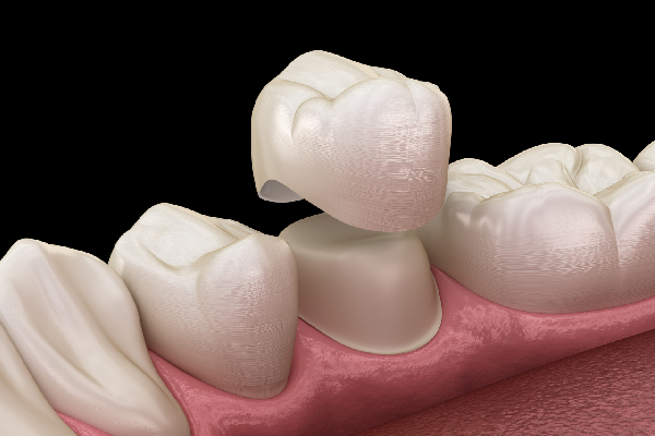 Dental Crown Step 2