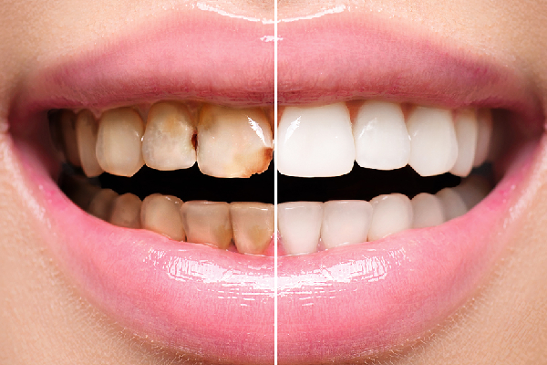 Dental Filling Procedure