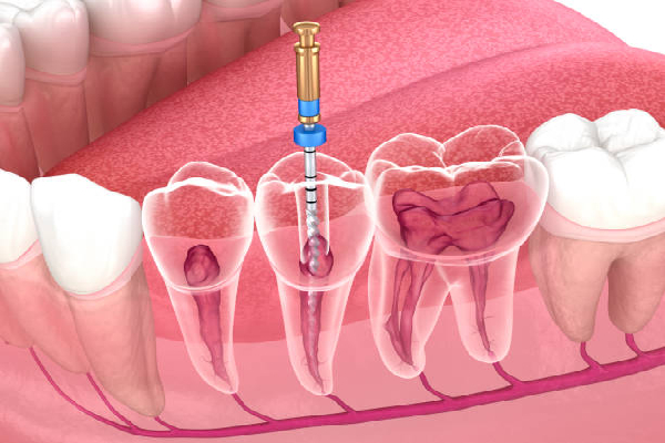 Tooth Restoration Process