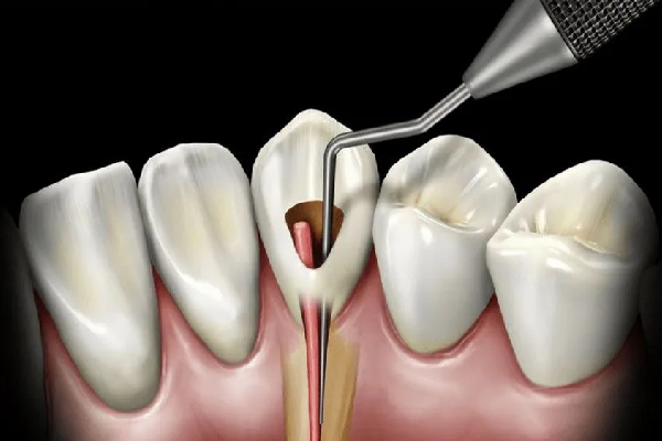 Healthy Smile After Fillings