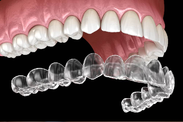 Final Invisalign Results