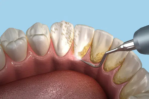 Plaque Removal Process