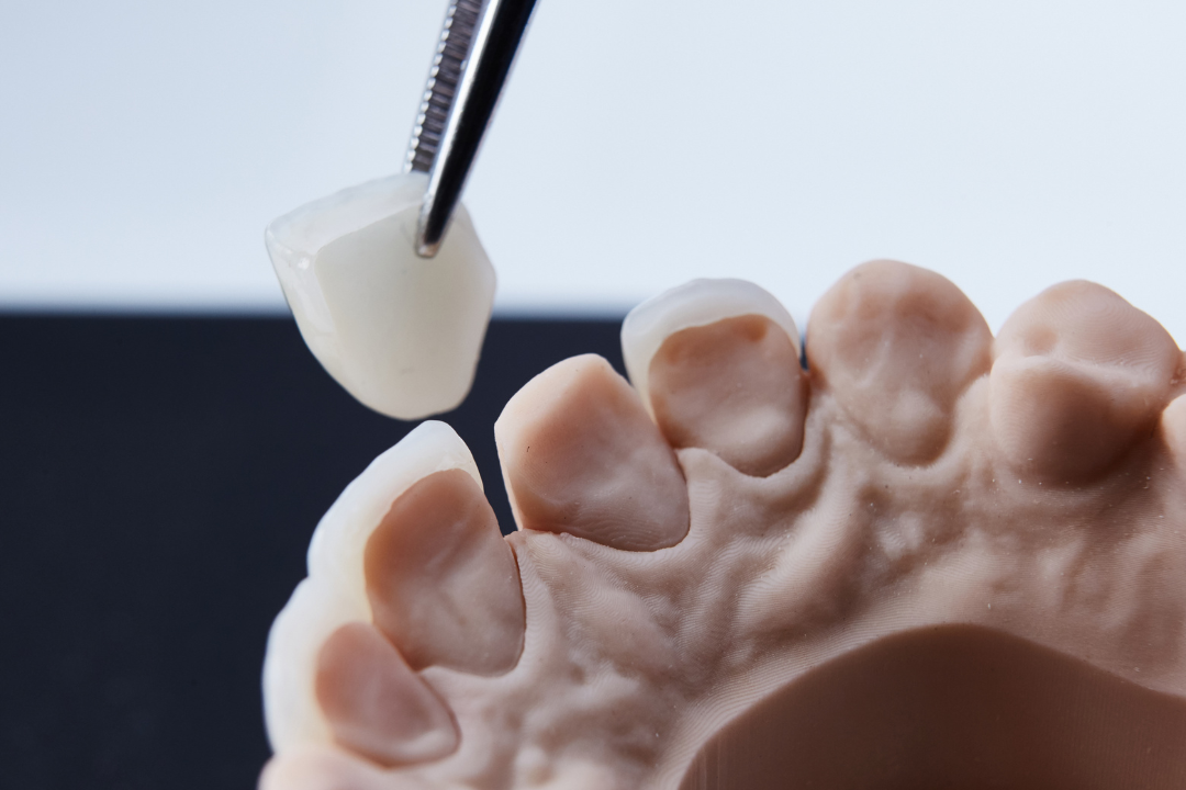 Dental Crown Step 3