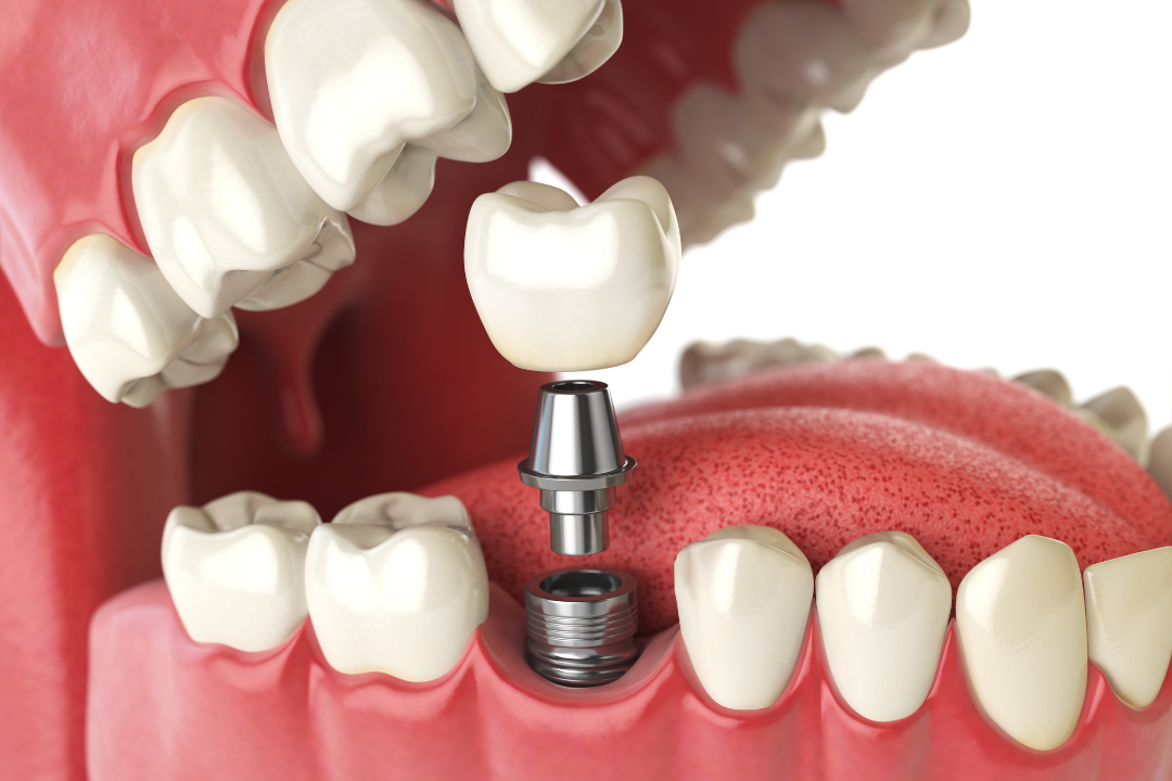 Dental Implant Additional Image