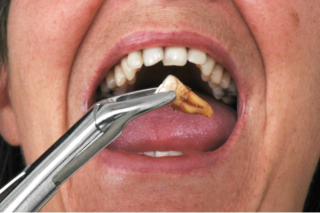 Post-Extraction Care