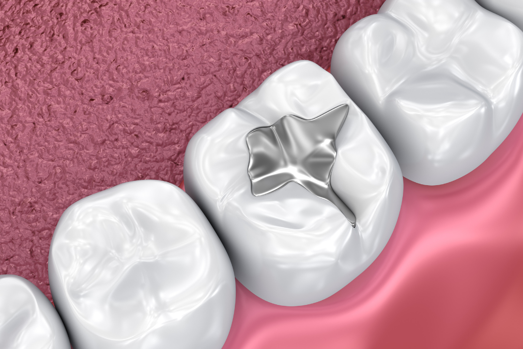 Healthy Smile After Fillings