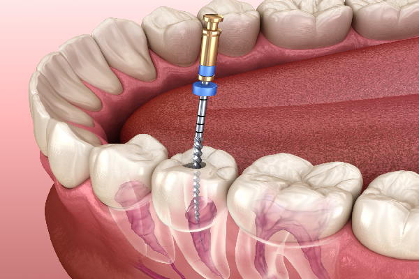 Root Canal Step 2