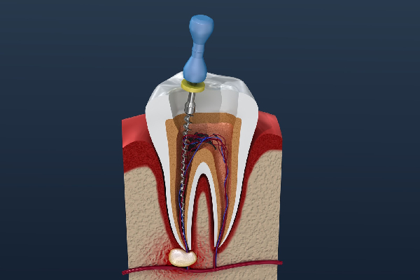Root Canal Step 3