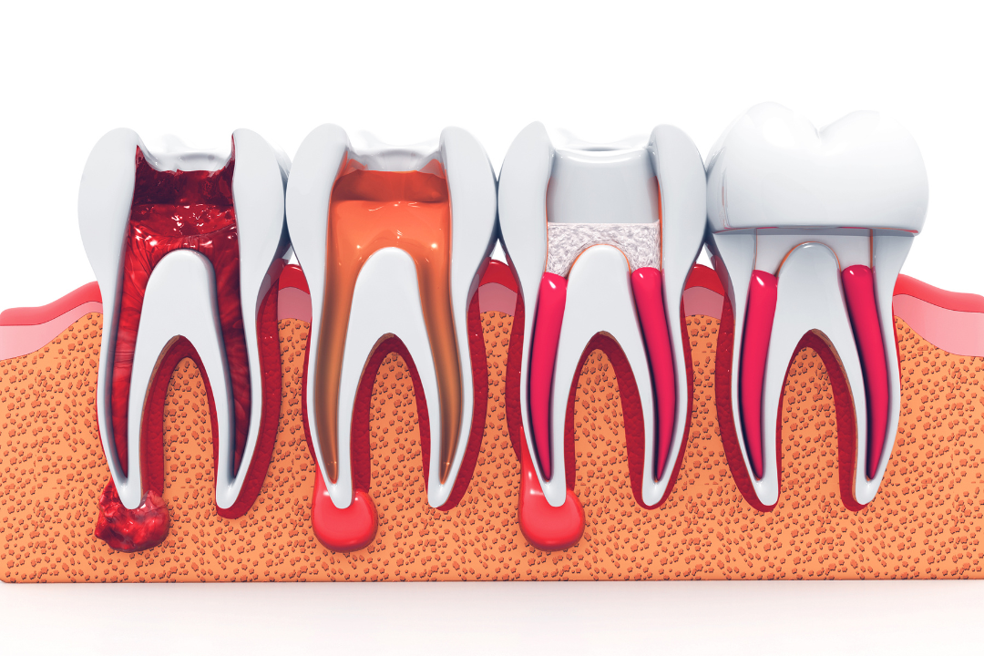 Root Canal Step 3