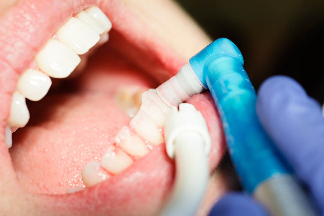 Polishing and Fluoride Treatment