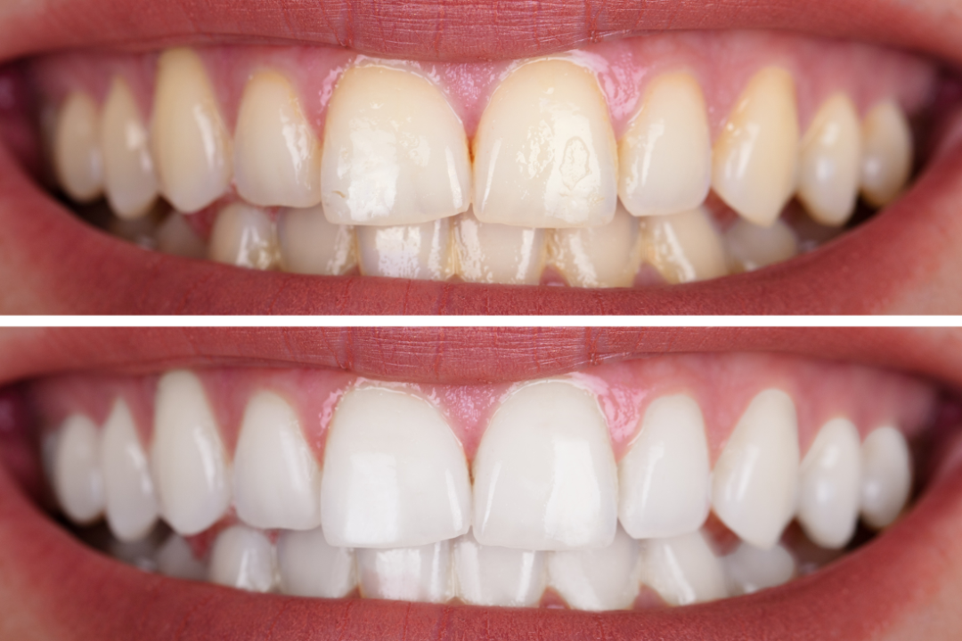 Bright & White Smile